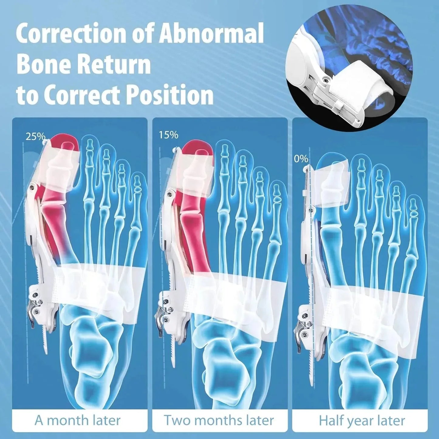 Bunion Corrector - Adjustable Bunion Splint
